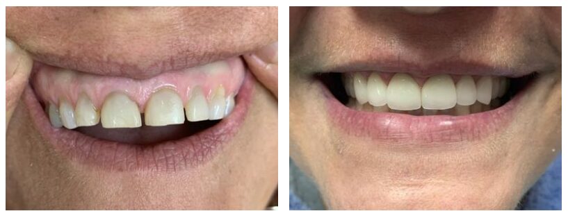 Before and after dental crowns in Cary NC