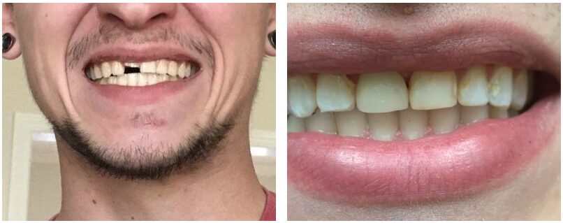 Dental patient before and after emergency crown treatment