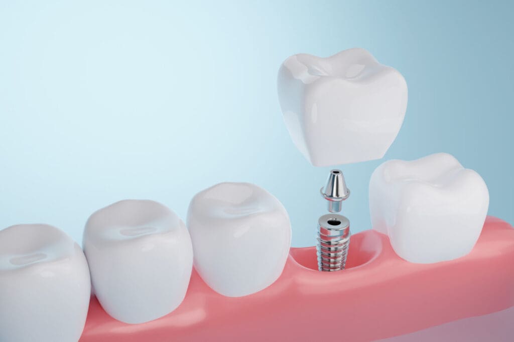 Single Dental Implants, Cary, NC