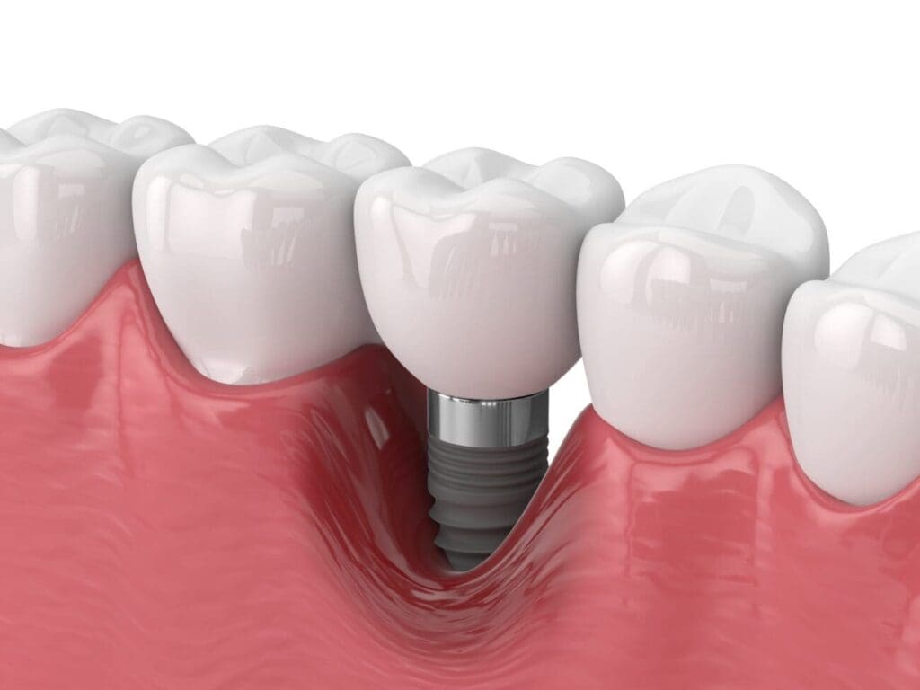 The cost of dental implants Cary NC